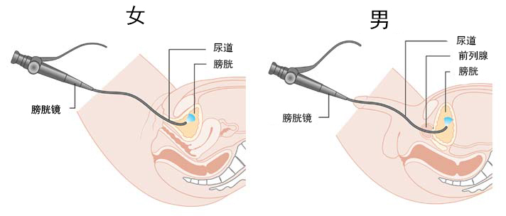 1542357890265594.jpg Female-Cystoscopy-Male-Cystoscopy